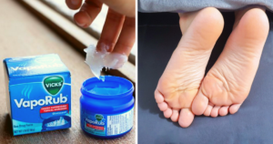 Home remedies for cracked heels 