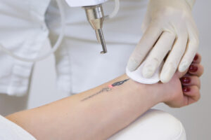 best laser tattoo removal clinics