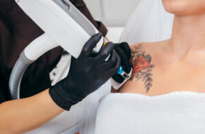 best laser tattoo removal clinics